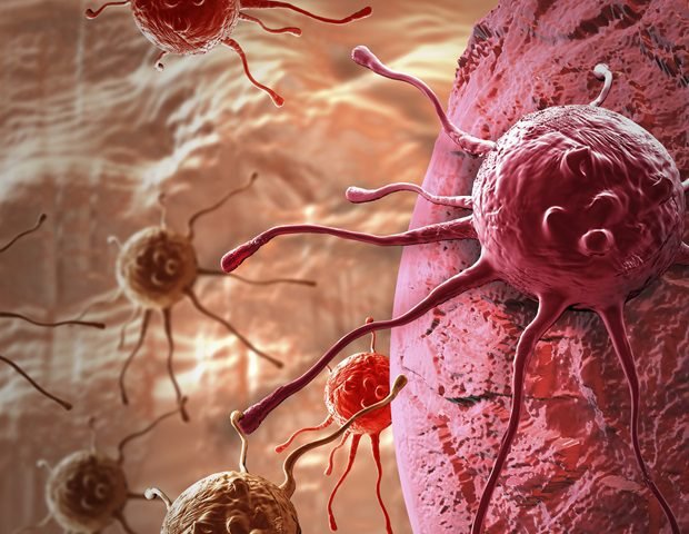 AI analysis of biopsy slides predicts rectal cancer treatment response