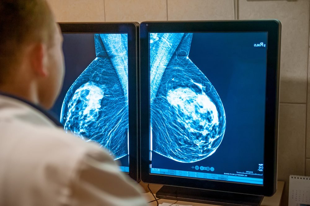 AI better at predicting breast cancer risk than density monitoring